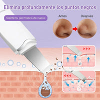 Depiladora De Puntos Negros Ultrasónica - Espátula Facial De Limpieza Profunda